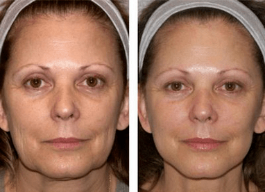 before and after