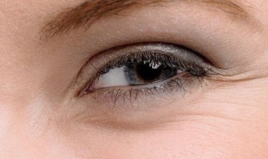 Wrinkles in the angles of the eyes